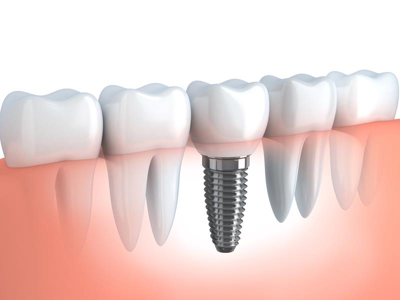 Dental Implants  Taylor, MI 